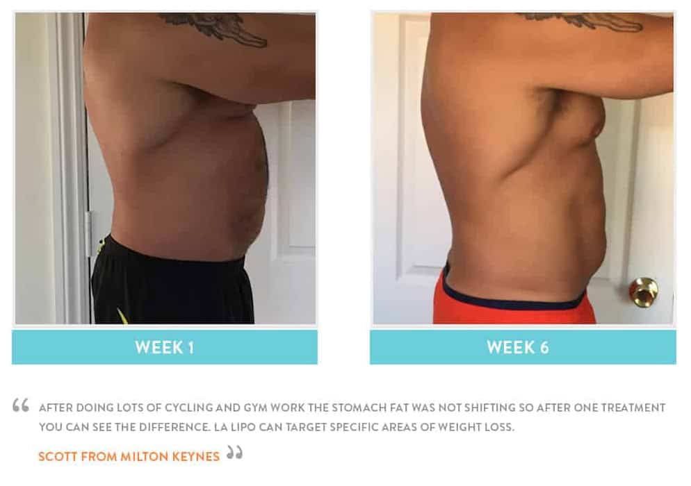 Before & After Stomach Fat Hampstead