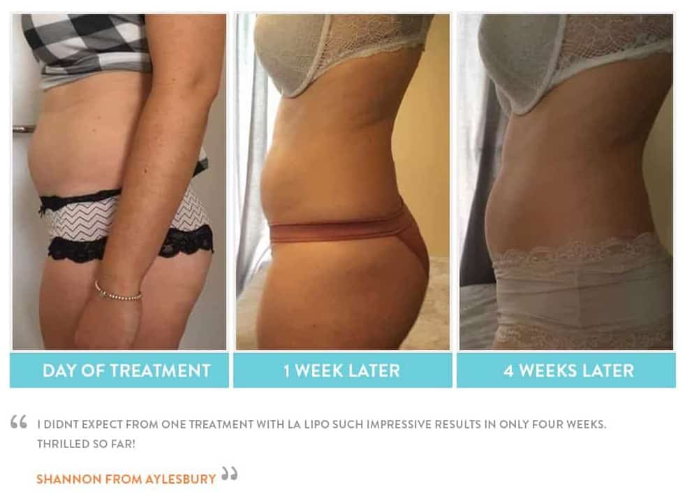before, Cryolipolysis Hampstead