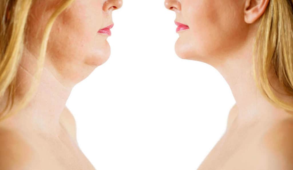 Double Chin treatment Hampstead before and after results