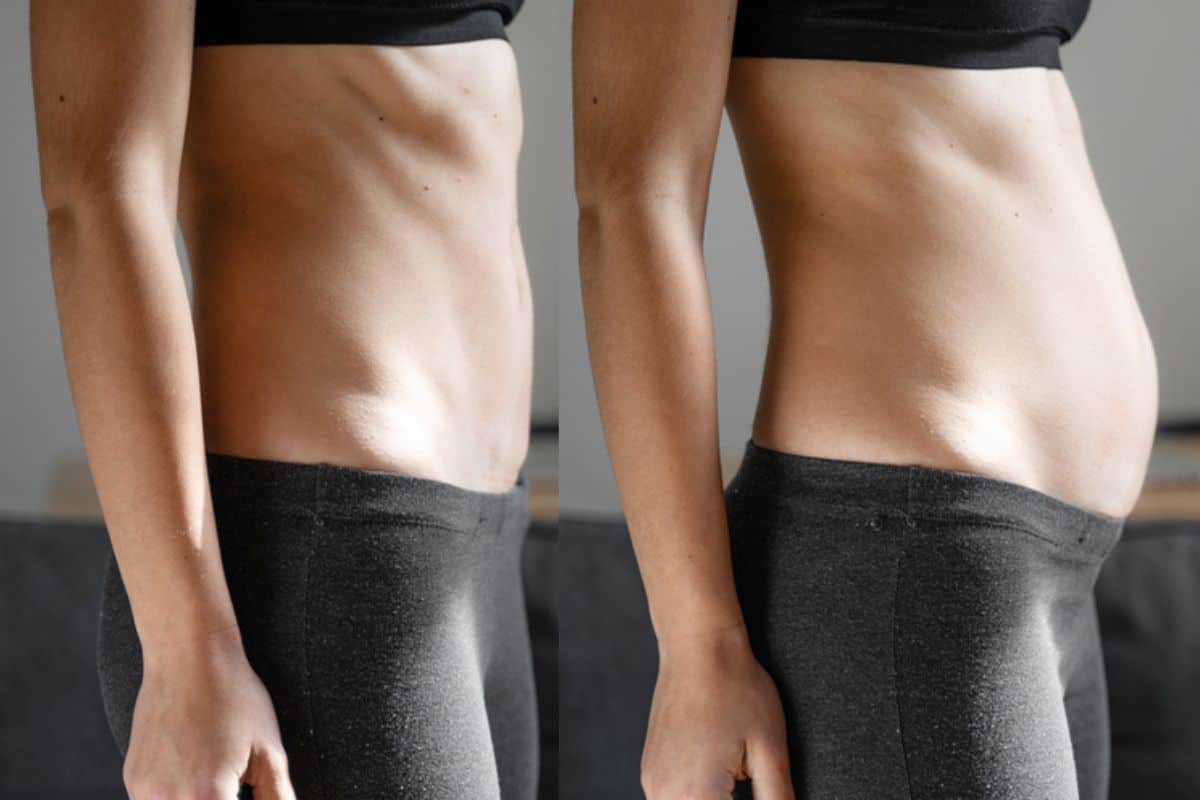 How long does diastasis recti take to improve Hampstead?