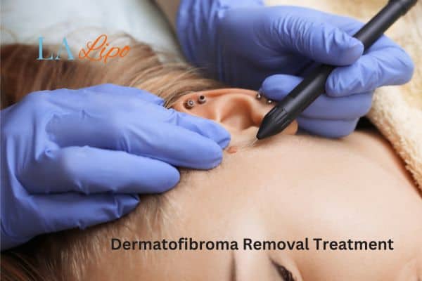 Dermatofibroma Removal Treatment Hampstead