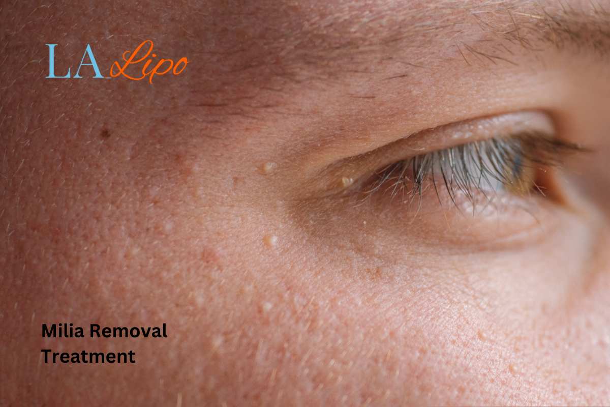 Cryopen Milia Removal: Is It the Easiest and Safest Option Hampstead?