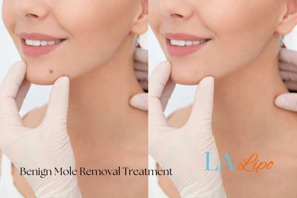 woman's before and after mole removal Hampstead results