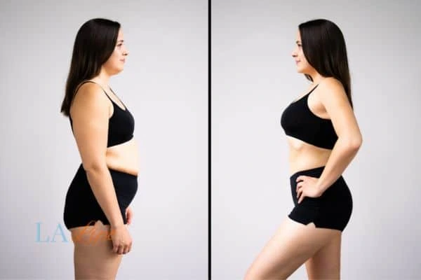 image of woman before and after results of LA-EMS Body Sculpting Hampstead to help treat Diastasis recti