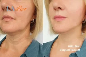 hi-fu for wrinkles Hampstead before and after results