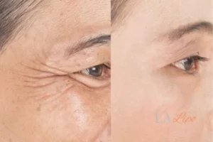 Before and after results of woman - HI-fu wrinkles reduction treatment Hampstead