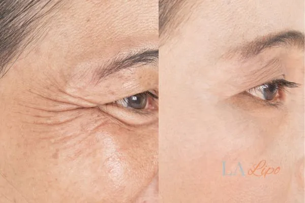 Before and after results of woman - HI-fu wrinkles reduction treatment Hampstead