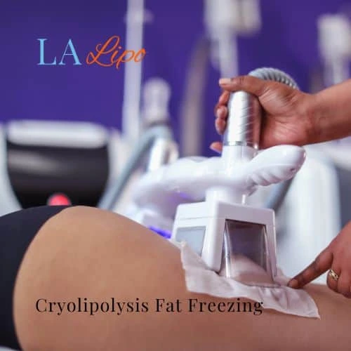 fat freezing - Cryolipolysis Hampstead