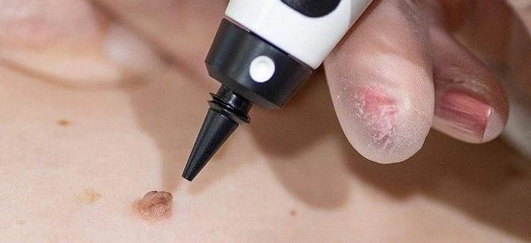 skin tag removal using cryopen Hampstead