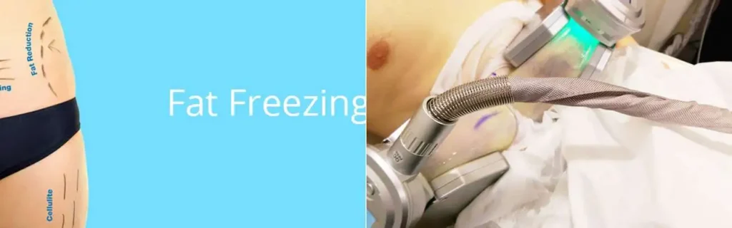 multi areas of a persons body having coolsculpting Hampstead treatment