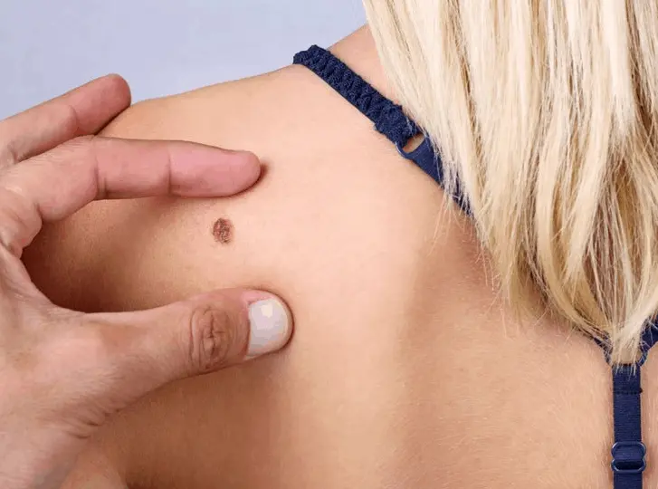 woman having mole removal Hampstead consultation before treatment.