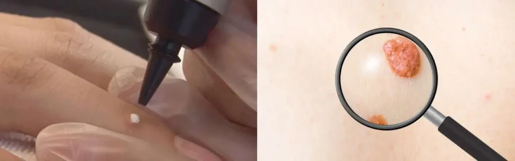 Cryopen for mole removal Hampstead - speak to our team today!