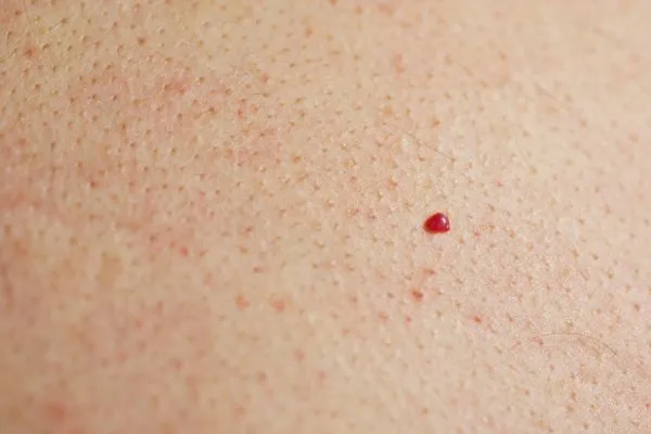 close up of a cherry angioma Hampstead