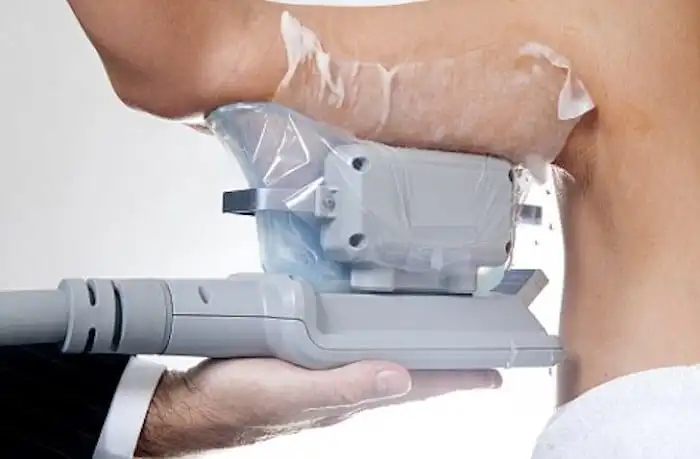 Picture of fat freezing Hampstead on the upper arms.