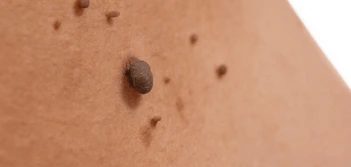 image of a skin tag Hampstead