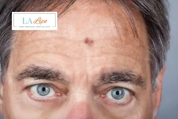 Solar Lentigo Removal Hampstead image of man with mark on his forehead