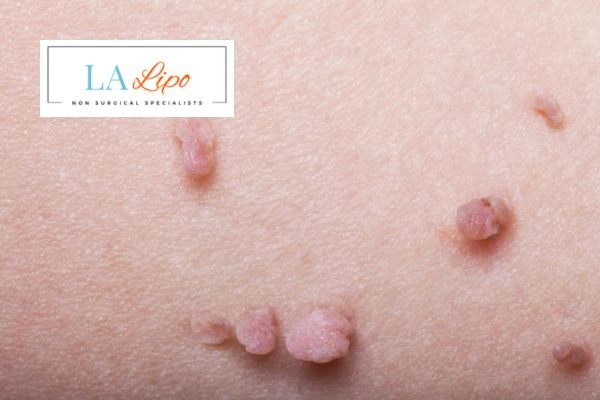 Does cryopen skin tag removal Hampstead hurt? Find out now call our team today!