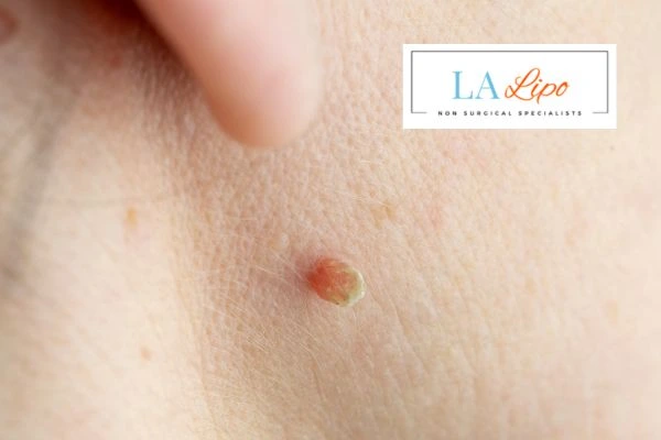 Book skin tag removal Hampstead today speak to our team now!
