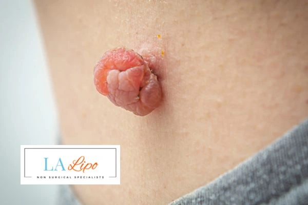 Interested in skin tag removal Hampstead? Concerned about the pain? Find out more today!