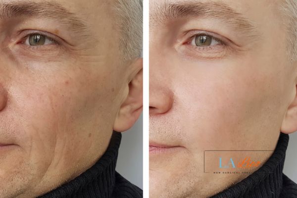 See the amazing results of Morpheus8 Treatment Hampstead!