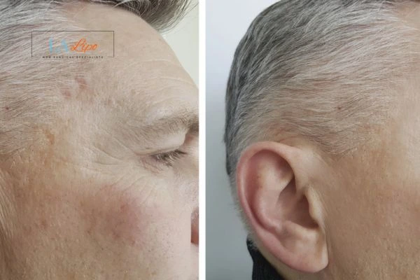 Mens Before & After Morpheus 8 Results Hampstead