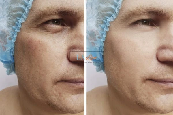 Before and after Morpheus 8 Results Hampstead