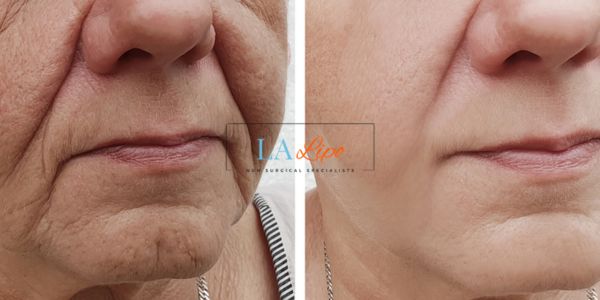 Older lady deeper wrinkle reduction - LA LIPO Morpheus 8 Results Hampstead