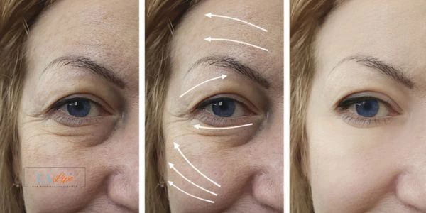 Amazing eye lift Morpheus 8 results Hampstead