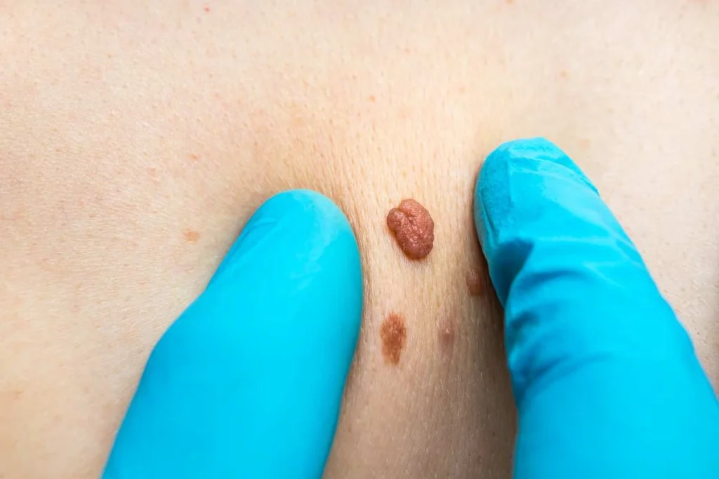 LA LIPO Cryopen Lesion Removal Prices Hampstead