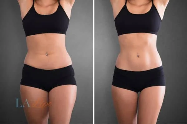 before and after results of non-surgical treatment to help a woman's body image and mental health Hampstead