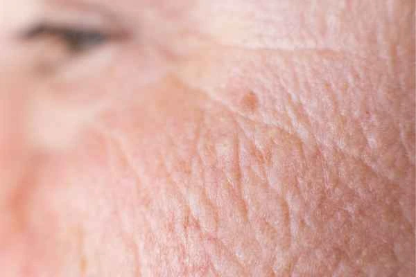 close up picture of a woman's face showing an age spot Hampstead