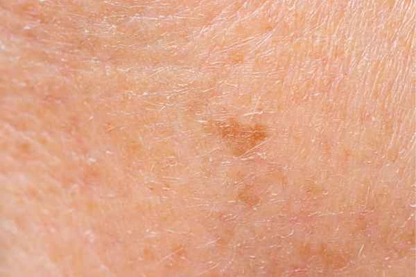 close up picture of age spots Hampstead