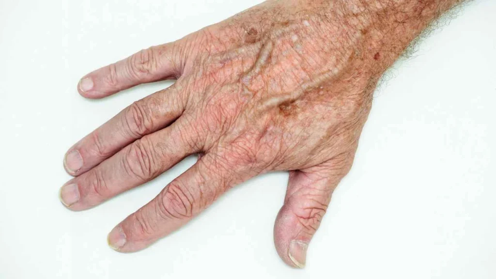 Male hand showing age spot Hampstead