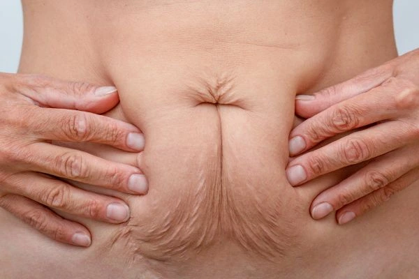 Should I Combine Diastasis Recti Treatment with Body Contouring for Better Results Hampstead?