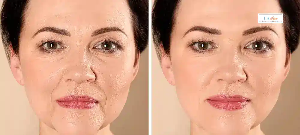 How Long Does It Take to See Results and How Long Do They Last Hampstead?