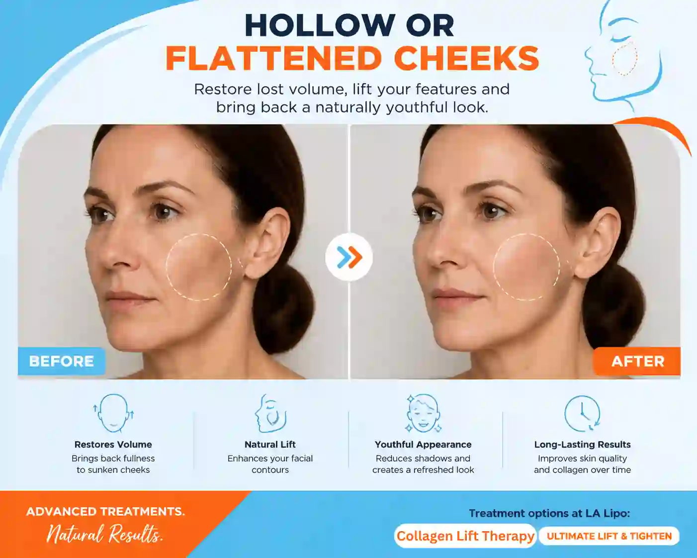 Sign #4: Hollow or Flattened Cheeks Hampstead